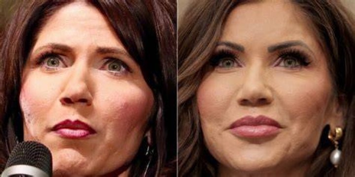 Kristi Noem Plastic Surgery Inside Her Plastic Surgery Procedures